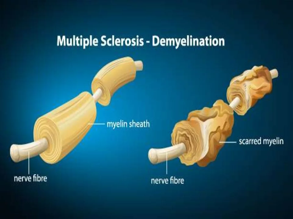 The potential use of dipyridamole in the treatment of multiple sclerosis