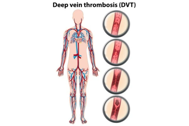 How to Reduce the Risk of Deep Vein Thrombosis During Long Flights